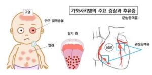 가와사키병 주요 증상