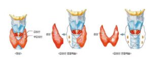 갑상선 유두암 수술