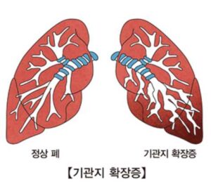 기관지 확장증