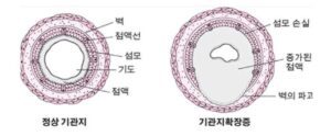 기관지 확장증 원인