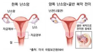 난소암 종류