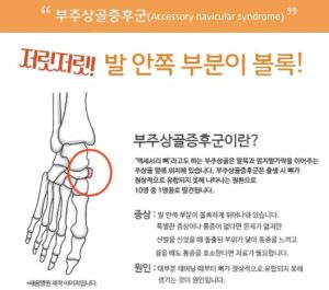 부주상골 증후군