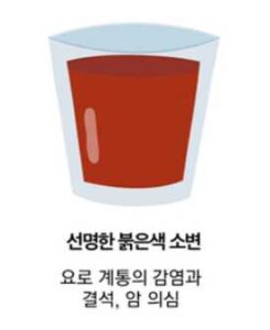 선명한 붉은색 소변