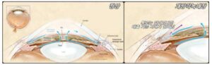 원발성 개방각 녹내장