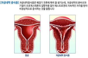 자궁내막 증식증