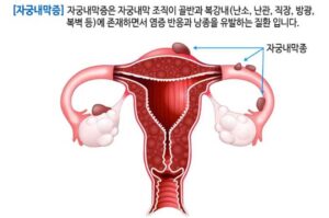 자궁내막증