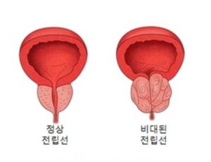 전립선비대증 증상