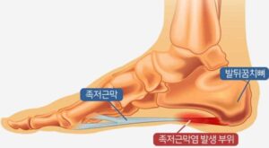 족저근막염