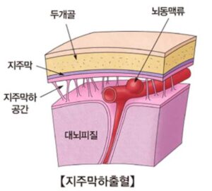 지주막하출혈 증상