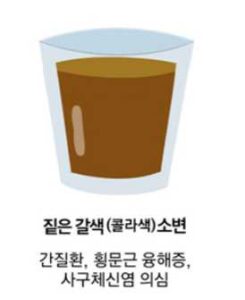 짙은 갈색 소변