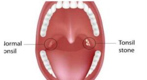 편도결석 생기는 이유