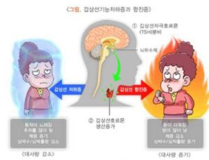 갑상선 항진증 증상