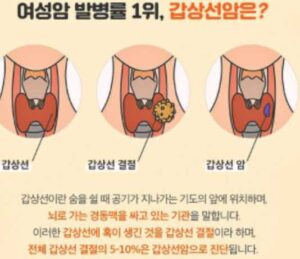 갑상선암 원인