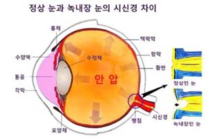 녹내장