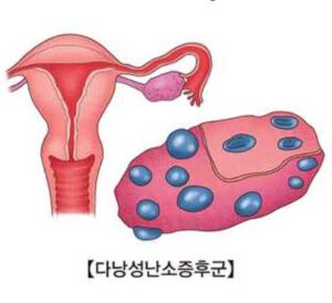 다난성 난소 증후군