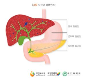 담관암 발생위치