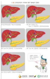 담관암 절제술