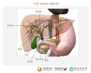 담도암