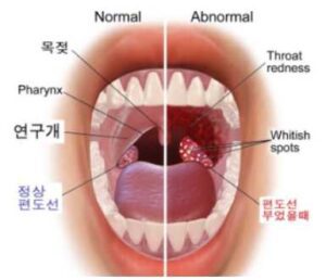 부은 편도