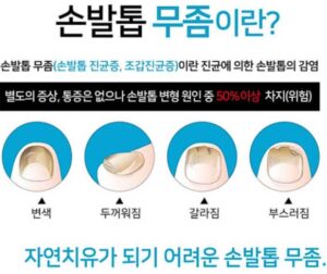 손발톱 무좀