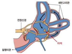 이석증이란