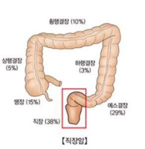 직장암