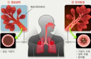 천신 증상