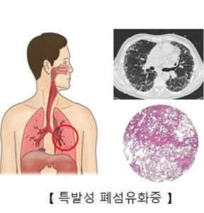 폐섬유증