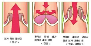 하지정맥류 원인