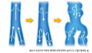 하지정맥류 증상