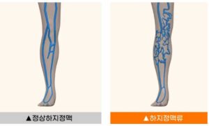 하지정맥류 차이