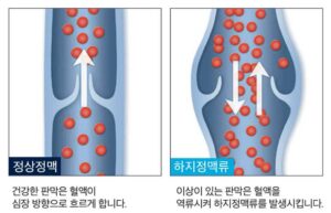 하지정맥류 치료